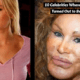 Celebrity Before-And-After Plastic Surgery Disasters